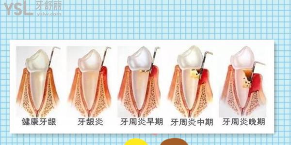 40歲牙齒脫落是什么原因引起的 如何防止牙齒脫落.jpg