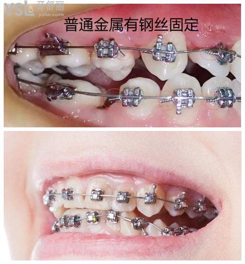 金屬自鎖牙套和傳統(tǒng)牙套的區(qū)別