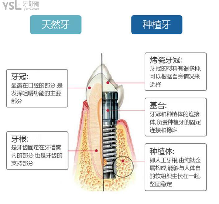 種植牙
