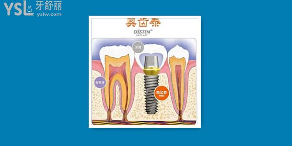 韓國奧齒泰的價位是多少 可以用幾年