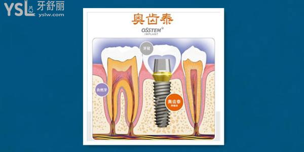 德國種植牙和韓國種植牙有什么區(qū)別 壽命差別大嗎