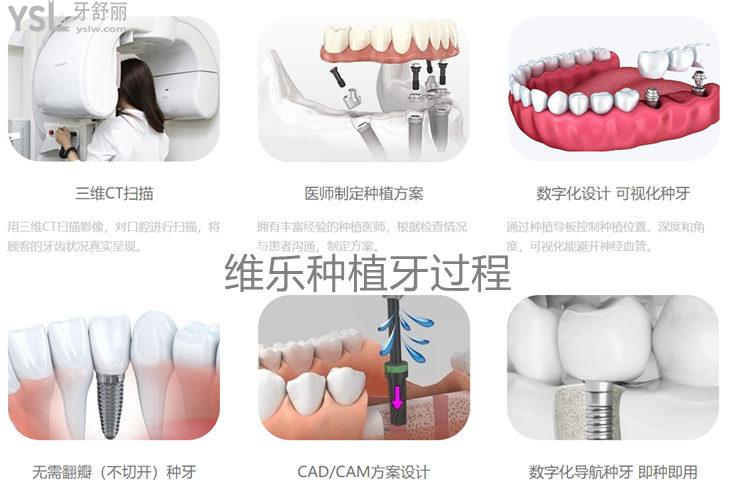 維樂口腔無錫維樂口腔種植牙價格表