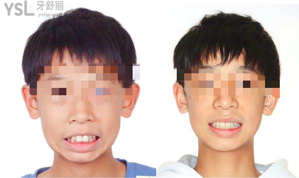 兒童牙齒矯正早期干預(yù)有用嗎