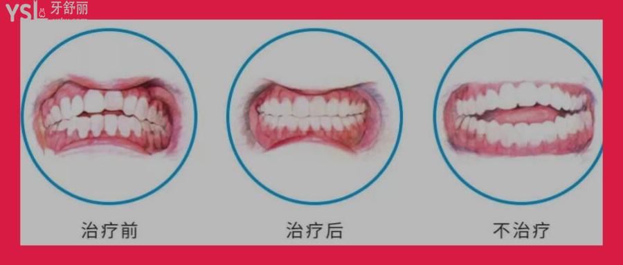 12歲牙齒矯正的后遺癥