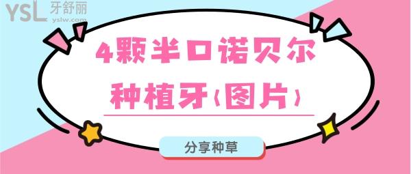 4顆半口諾貝爾種植牙(圖片)