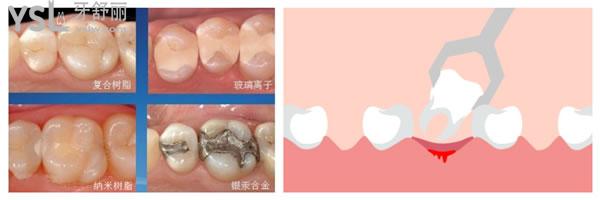 補(bǔ)牙和拔牙圖片