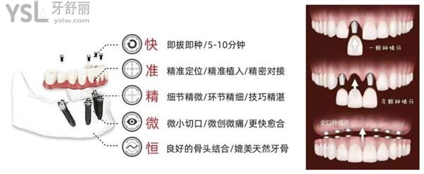 即刻負(fù)重種植牙優(yōu)勢