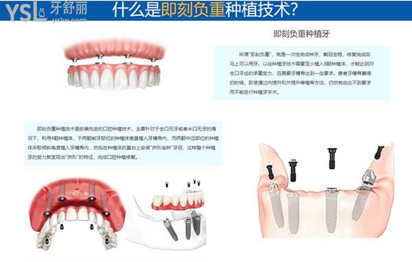 什么是即刻負(fù)重種植技術(shù)