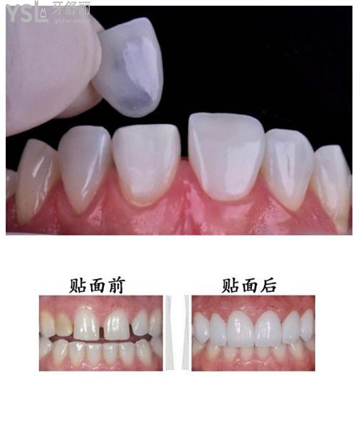 瓷貼面修復(fù)對(duì)比圖