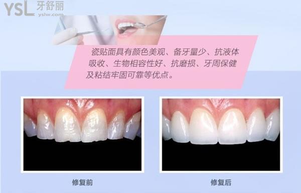 瓷貼面修復(fù)