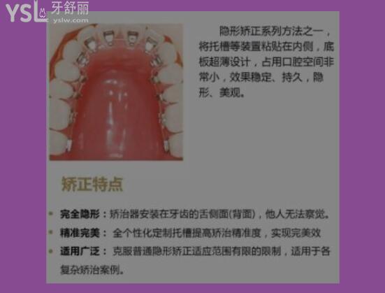 能做舌側(cè)矯正的是不是**的
