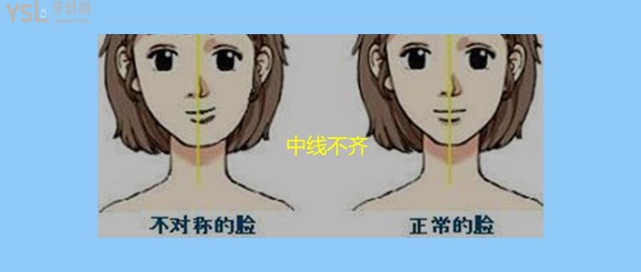矯正牙齒中線不齊要緊嗎