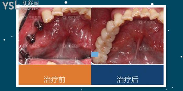 南寧市立口腔門診收費標(biāo)準(zhǔn)更新 親診患者說 醫(yī)生技術(shù)好價格便宜還能刷**.jpg