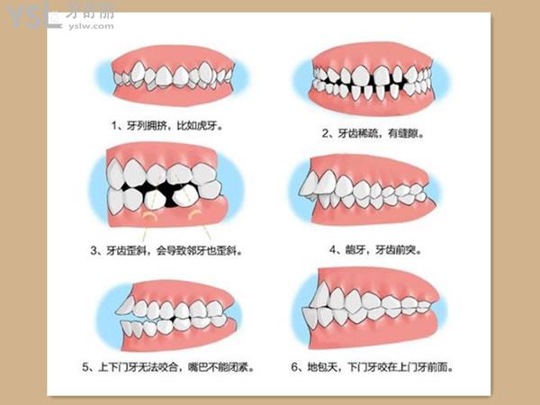 牙齒畸形的類型