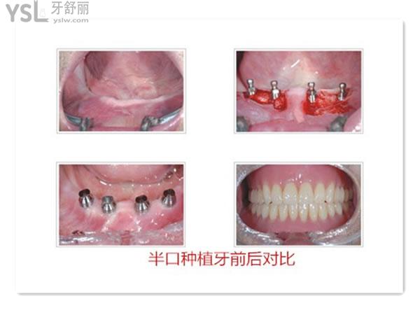 all-on-4半口種植術(shù)后圖