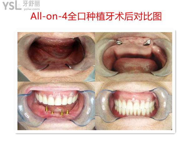 all-on-4全口種植術(shù)后圖