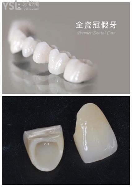 全瓷牙圖片
