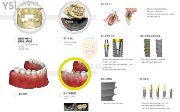 韓國(guó)登騰二代是幾年產(chǎn)出的，韓國(guó)登騰二代種植牙壽命是多少年