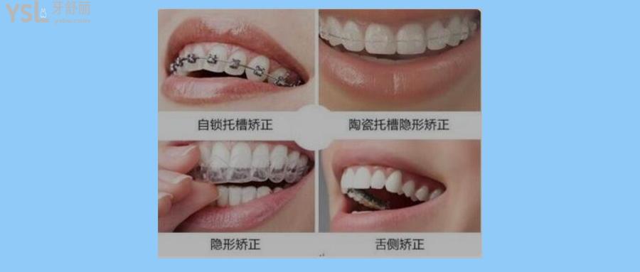 牙套有哪幾種類(lèi)型圖片