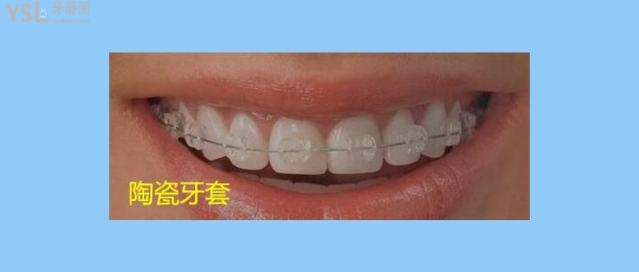 牙套有哪幾種類(lèi)型圖片