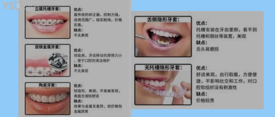牙套有哪幾種類(lèi)型圖片