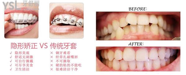 牙齒矯正優(yōu)勢
