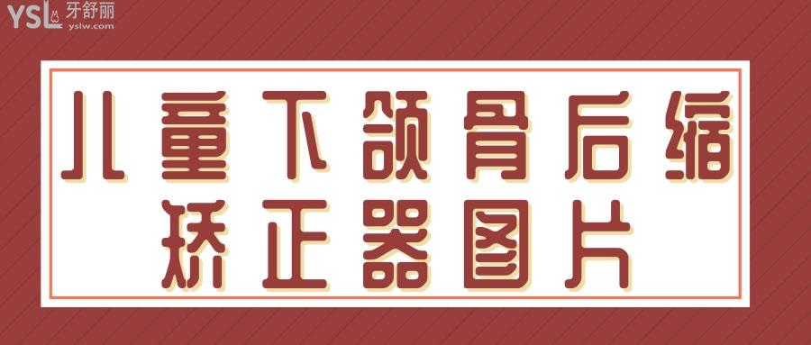 兒童下頜骨后縮矯正器圖片