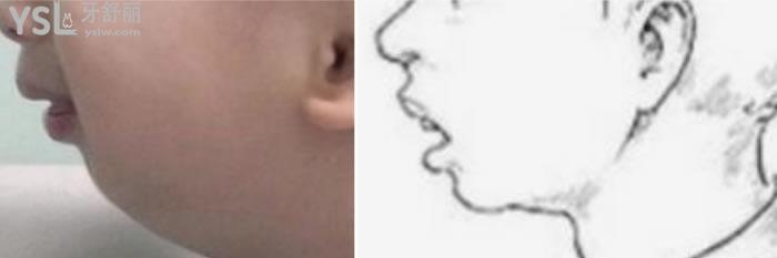 兒童下頜骨后縮矯正器圖片