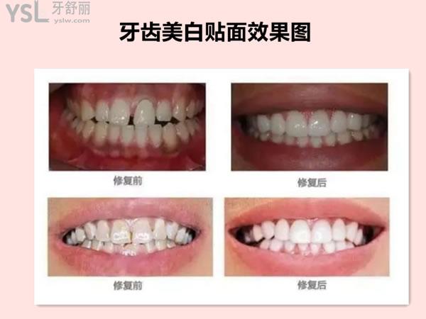 牙齒美白貼面圖