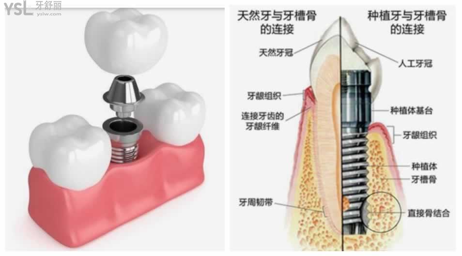 為什么會有人說種植牙本身就是個騙局
