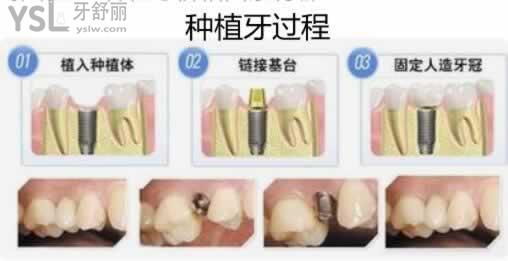 為什么會有人說種植牙本身就是個騙局