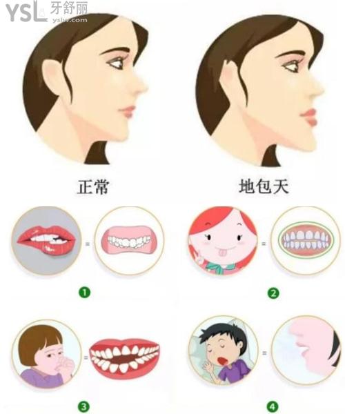 地包天牙齒矯正費(fèi)用多少錢