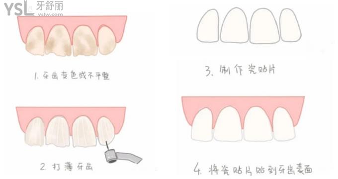 牙齒貼面制作過程