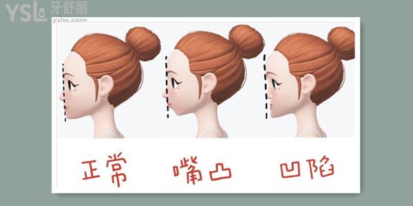 請問嘴凸除了戴牙套還有什么辦法.jpg