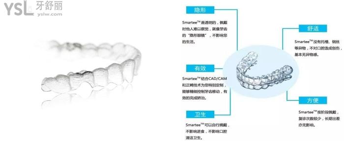 隱形牙套的優(yōu)點(diǎn).jpg
