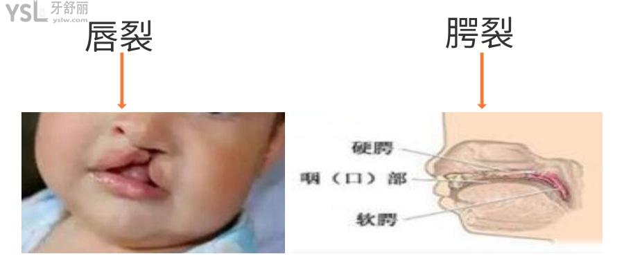 唇裂和腭裂哪個(gè)重