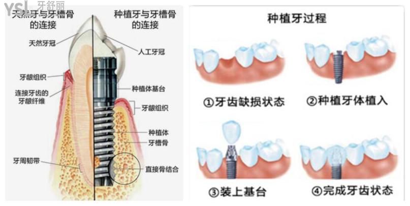 口腔醫(yī)院種牙多少錢
