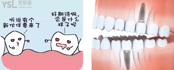 在醫(yī)院一般種植一顆牙要花多少錢，人工種植牙能用多久？.jpg