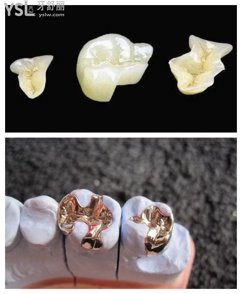 牙齒修復(fù)的幾種方法微樁是什么意思