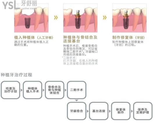 奧齒泰種植牙和登騰種植牙哪個(gè)好.jpg