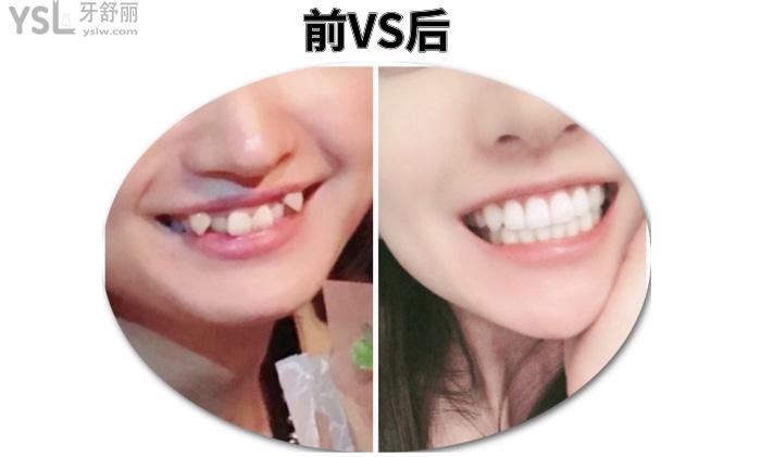成人盡量不要矯正牙齒？究竟是有風(fēng)險(xiǎn)還是怕你<span style=