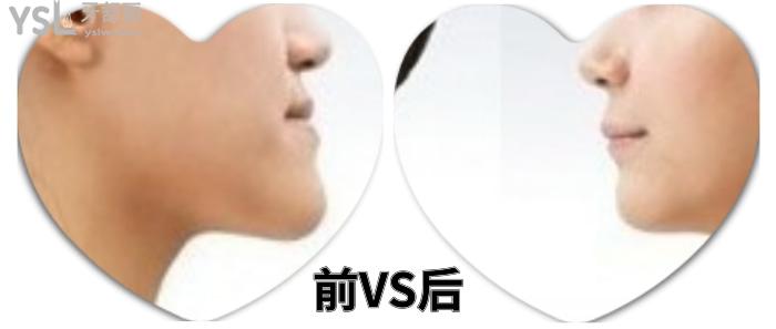 成人盡量不要矯正牙齒？究竟是有風(fēng)險(xiǎn)還是怕你<span style=