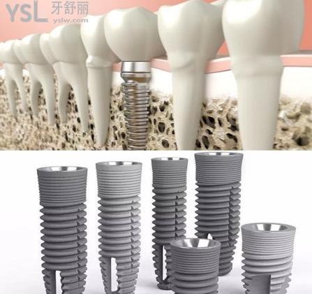 瑞典諾貝爾種植牙質(zhì)量和價(jià)格.jpg