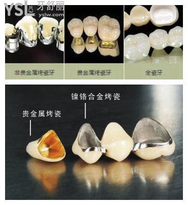 成都烤瓷牙和全瓷牙的價(jià)格表
