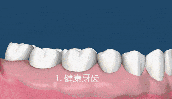 網(wǎng)上透明牙套真的可以矯正嗎.gif