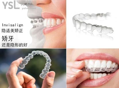 隱適美矯正適合多大年齡.jpg