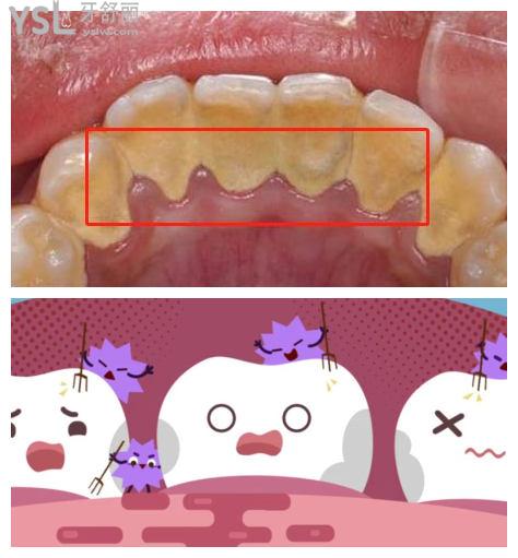 成都洗牙一般多少錢(qián)