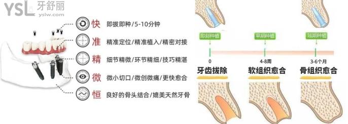 即刻種植早期種植延期種植的優(yōu)缺點(diǎn)