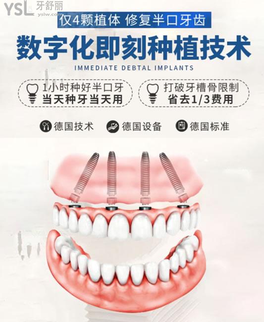 深圳諾德齒科種植牙技術(shù)優(yōu)勢