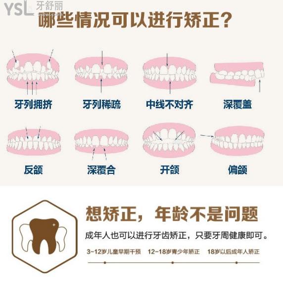 哪些情況可以進(jìn)行牙齒矯正